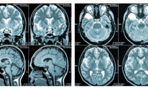 Brain Injuries After COVID Vaccination