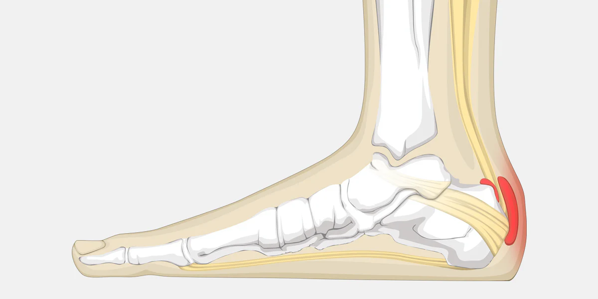 Relieving Achilles Bursitis Pain: The Benefits of Aerosol Can Therapy