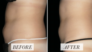 Fat Reduction Treatments: The Science, The Results, And Everything In Between