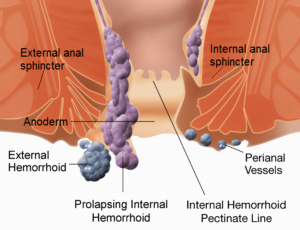 Piles Causes Symptoms