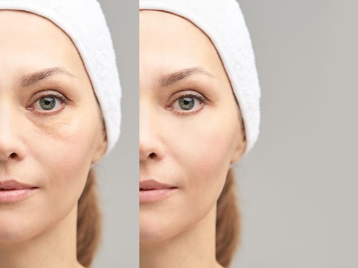 ultherapy versus thermage results 1