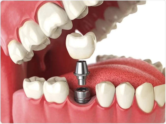 Dental Implant Healing