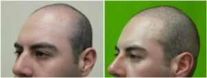 Microneedle Hair Transplant: Navigating the Future of Follicular Restoratio