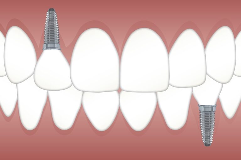 Answers to Your Burning Questions About Dental Implants