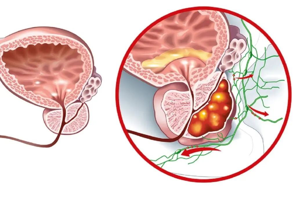 Prostate Cancer Detection Simplified with OncoTrace