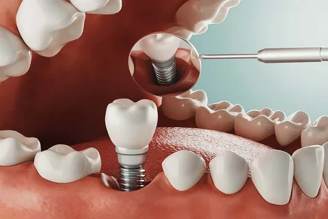 What Are Dental Implants, and How Do They Work?