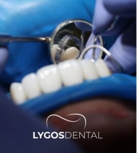 Laminate Veneer: Shape Your Smile
