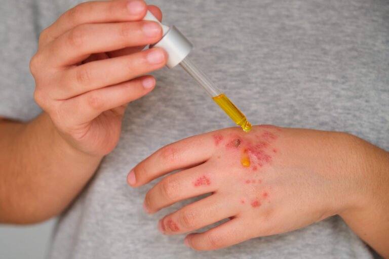 Affordable Care for Chronic Eczema: How to Plan Your Long-Term Budget