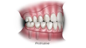 Occlusion Basics For Implant Dentures: Why Bite Matters